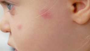 Co dělat, když dítě kousne komáry